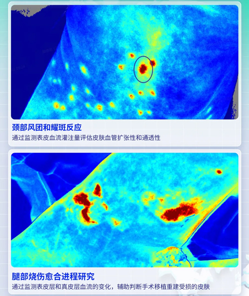 pt真人游戏官网激光散斑血流成像系统获批FDA认证