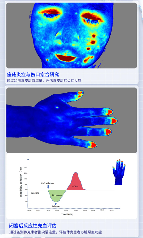 pt真人游戏官网激光散斑血流成像系统获批FDA认证