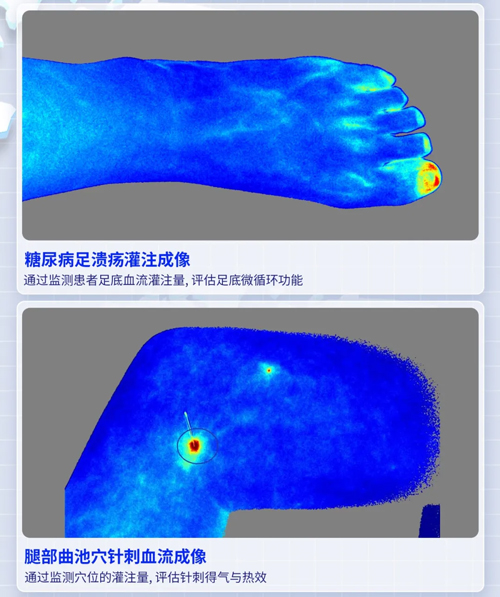 pt真人游戏官网激光散斑血流成像系统获批FDA认证
